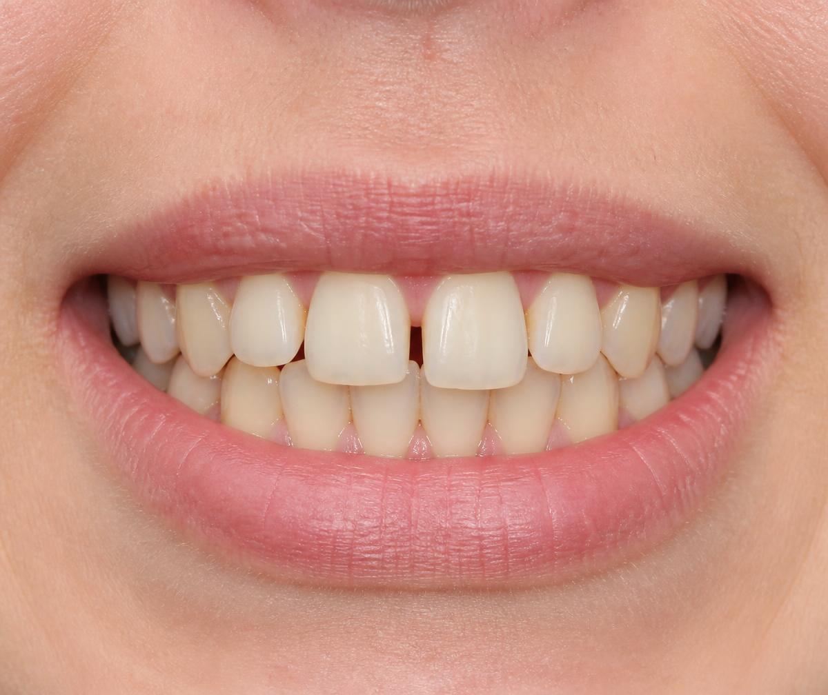 Smile before cosmetic treatment